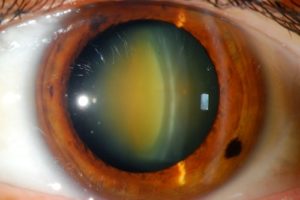 Nuclear sclerotic cataract